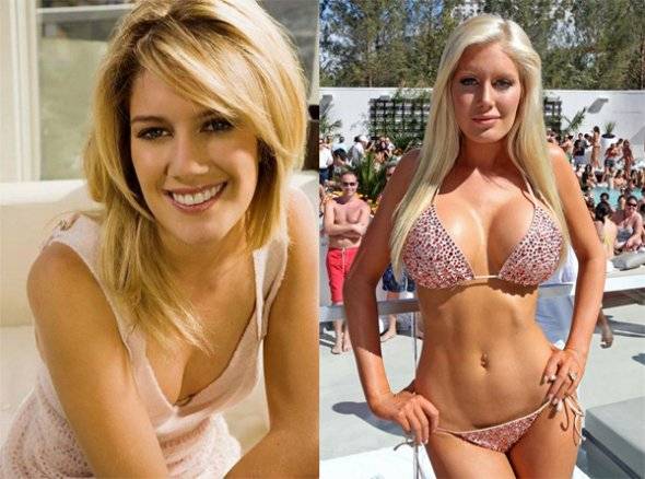 Celebrities: Before and After Plastic Surgery